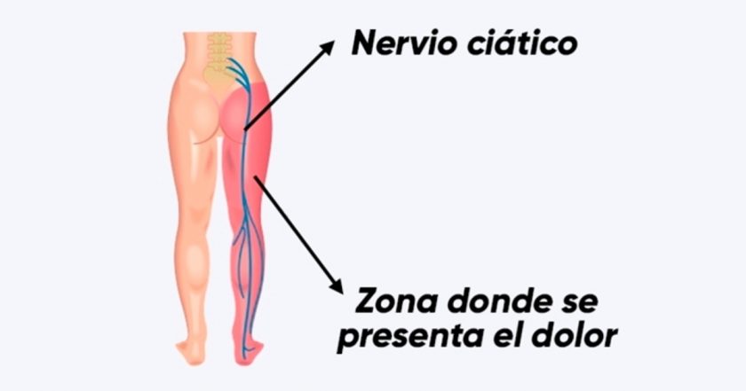 aliviar el dolor del nervio ciático nervio ciatico