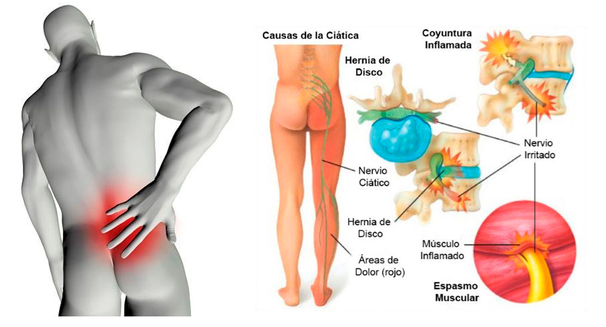 ¿cuáles Son Las Causas De La Ciática Ciaticaemk 4843