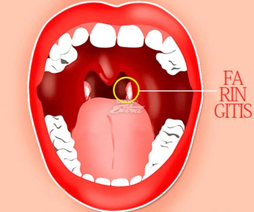 ¿Qué es la faringitis? - Salud Salud Para Todos