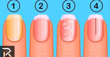 síntomas de las uñas