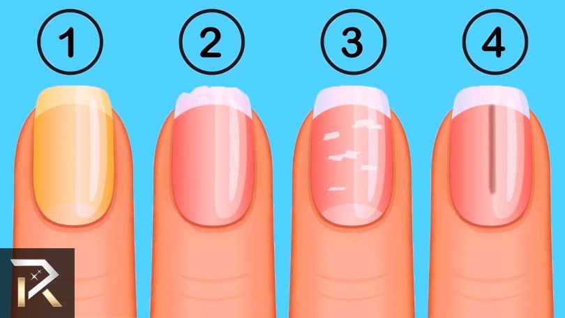síntomas de las uñas
