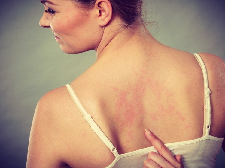 eczema dermatitis dermatitis dermatitis dermatitis