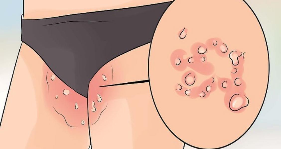 Remedios caseros para la psoriasis inversa