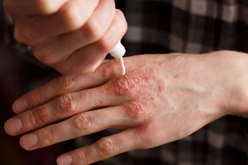 Psoriasis
