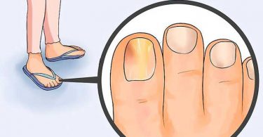 Remedios caseros para los hongos en las uñas.