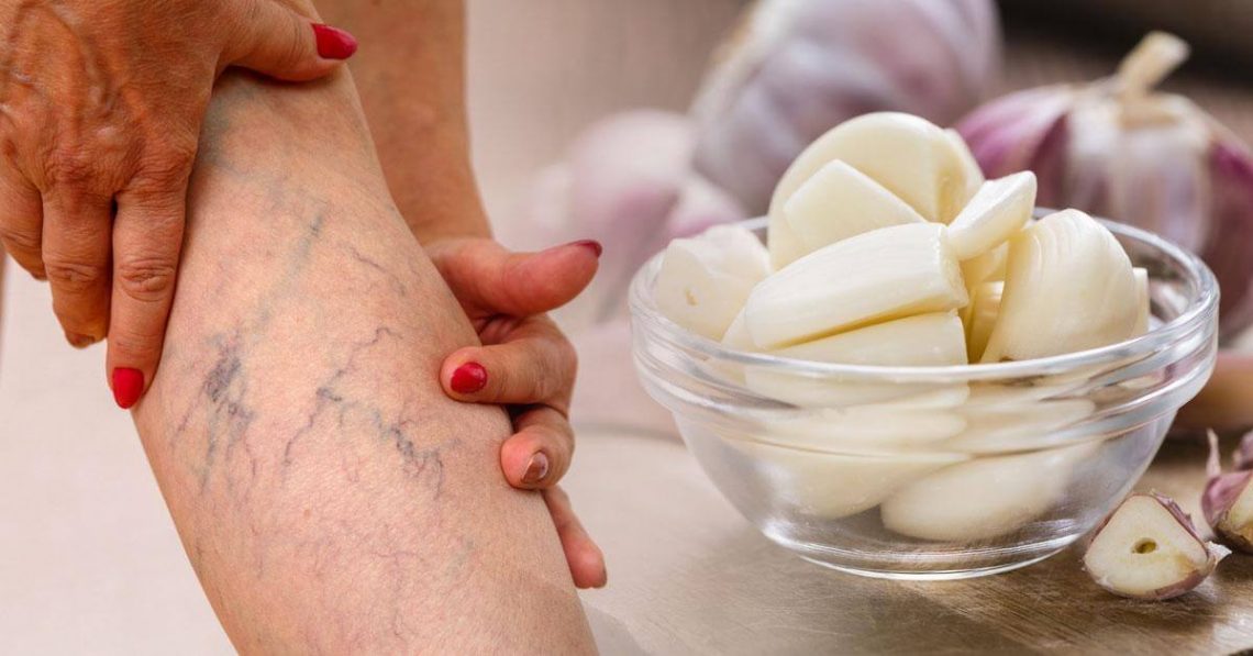 Remedios caseros para las varices y arañitas