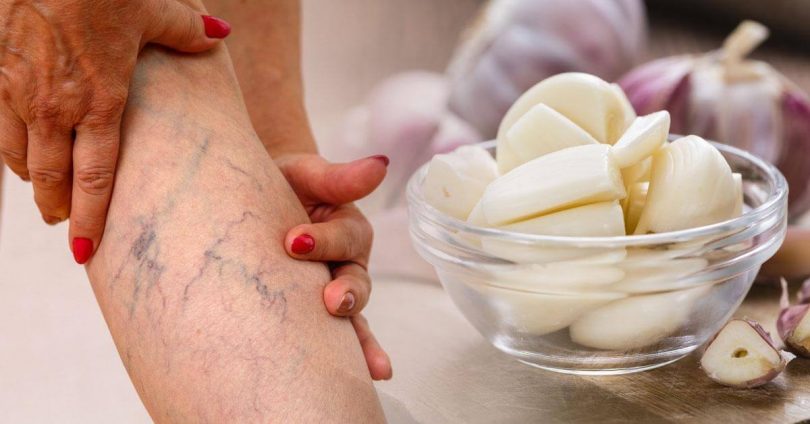 Remedios caseros para las varices y arañitas