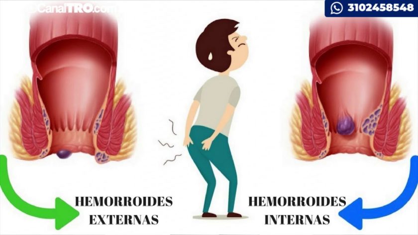 cirugia Proctológica2