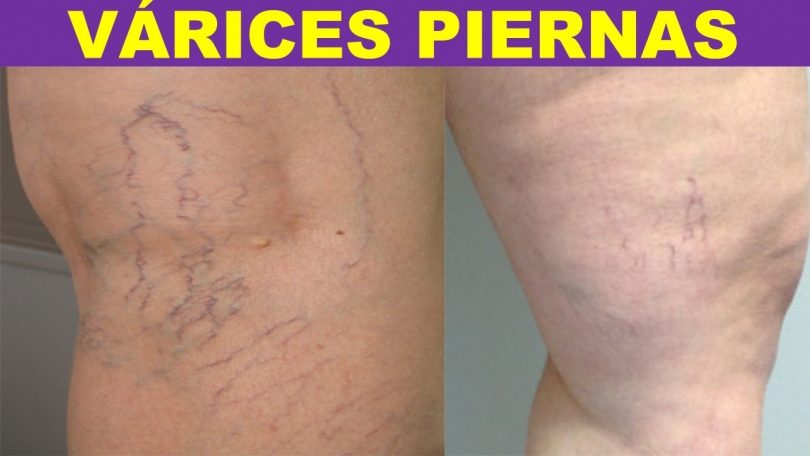 varices tratamiento