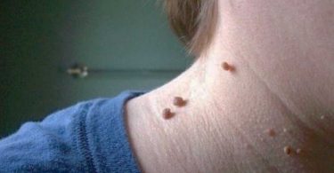 como-eliminar-las-verrugas