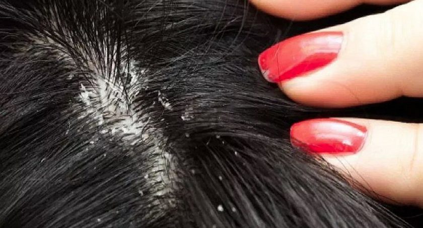 remedios caseros para eliminar la caspa