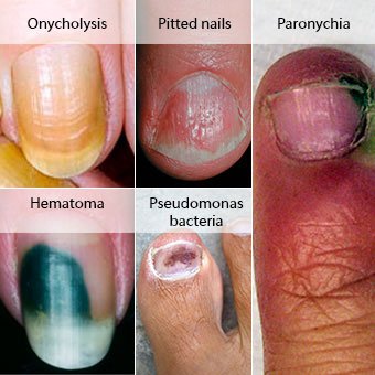 clinicas para tratamiento de hongos en las uñas