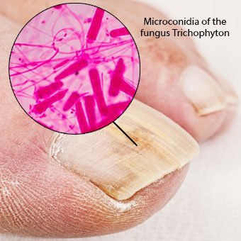 clinicas para tratamiento de hongos en las uñas