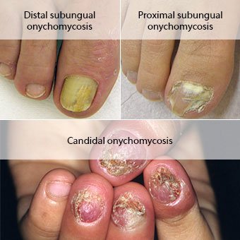 clinicas para tratamiento de hongos en las uñas