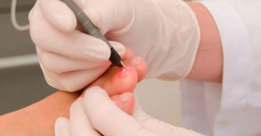 Tratamientos láser para los hongos en las uñas