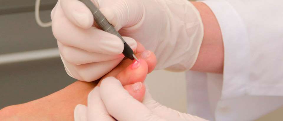 Tratamientos láser para los hongos en las uñas