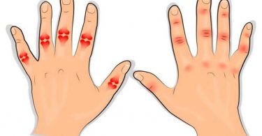 Remedios caseros para la artritis en las manos