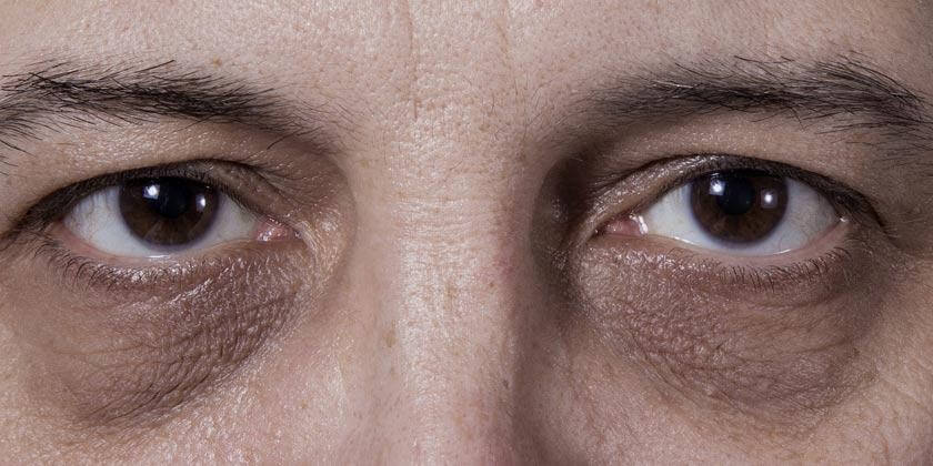 Remedios caseros para las ojeras marcadas