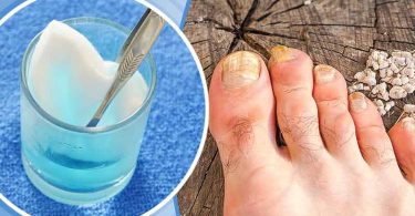 agua oxigenada para hongos uñas