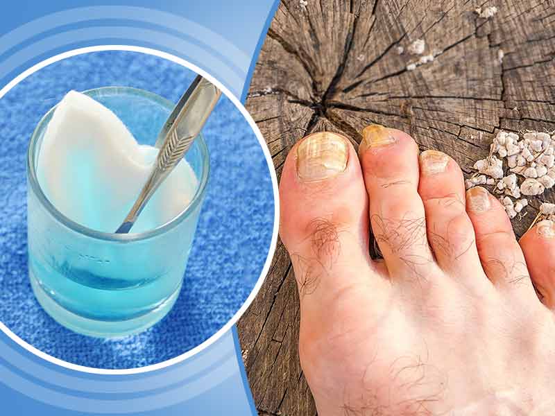 agua oxigenada para hongos uñas