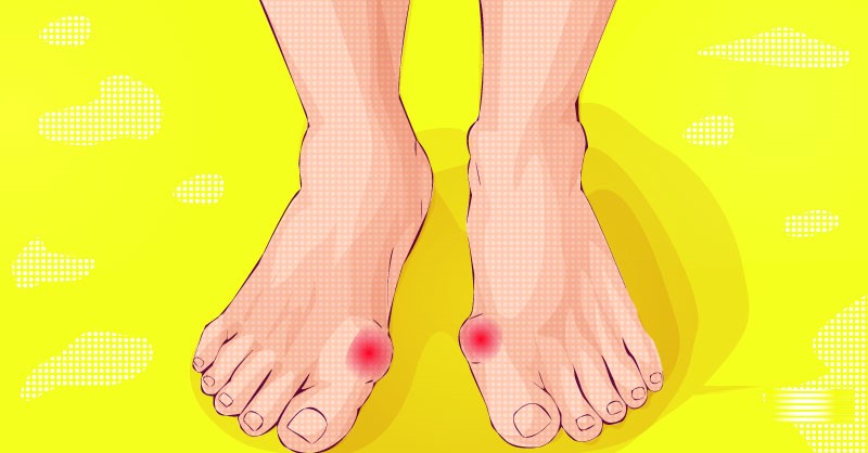 10 Remedios caseros para curar juanetes