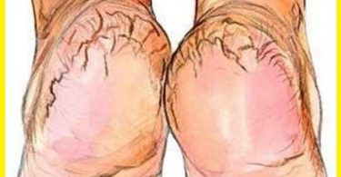 10 Remedios caseros para los callos en los pies