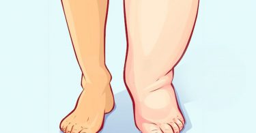 remedios caseros para la retención de líquidos en los pies