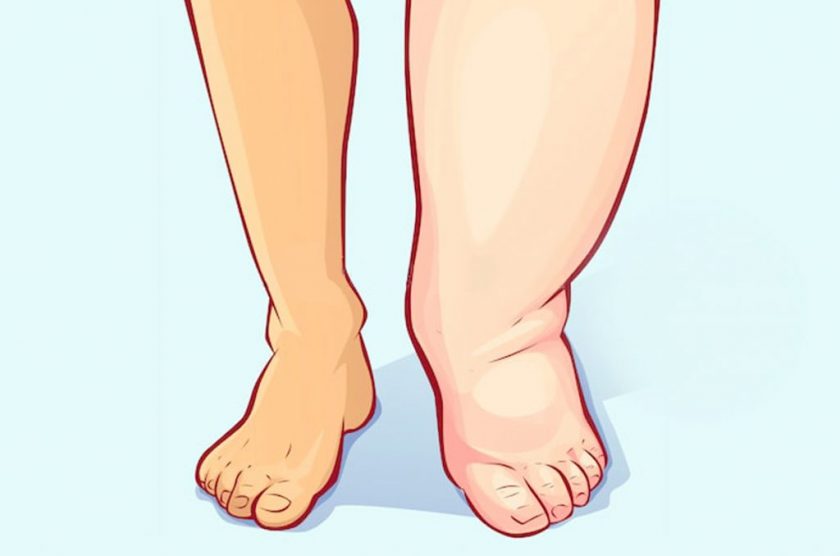 remedios caseros para la retención de líquidos en los pies