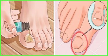 Remedios caseros para hongos en las uñas de los pies