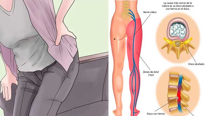 Como desbloquear el nervio ciático para eliminar el dolor