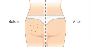 12 Remedios caseros para eliminar los granos en los glúteos