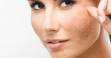 Remedios caseros para eliminar manchas oscuras en la cara
