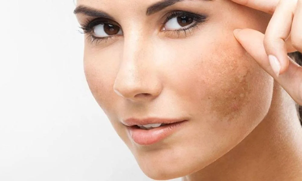 Remedios caseros para eliminar manchas oscuras en la cara