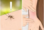 remedios caseros para picaduras de mosquitos