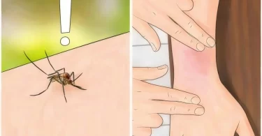 remedios caseros para picaduras de mosquitos