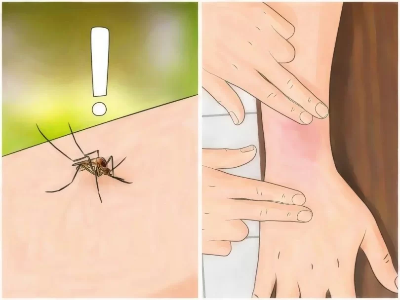 remedios caseros para picaduras de mosquitos
