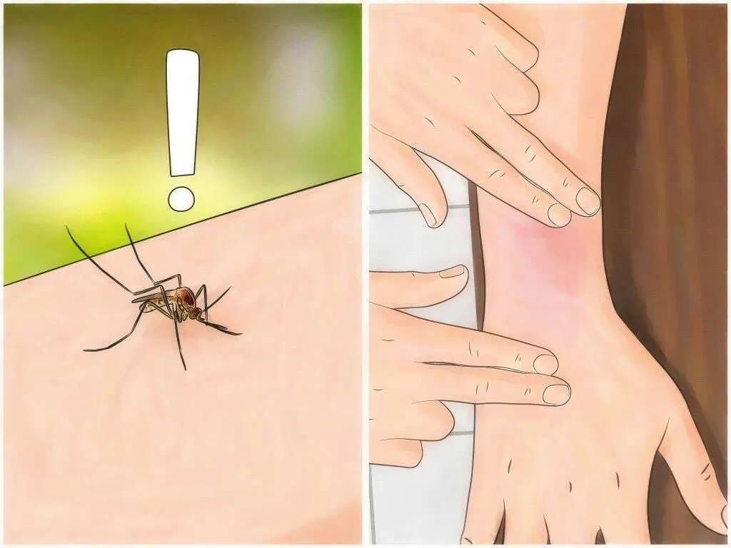 remedios caseros para picaduras de mosquitos