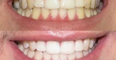 Eliminar el sarro dental de forma segura y eficiente en tu hogar