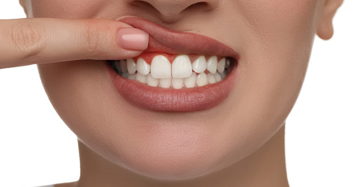 encías retraídas remedios caseros