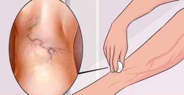 Es dolorosa la operación de varices