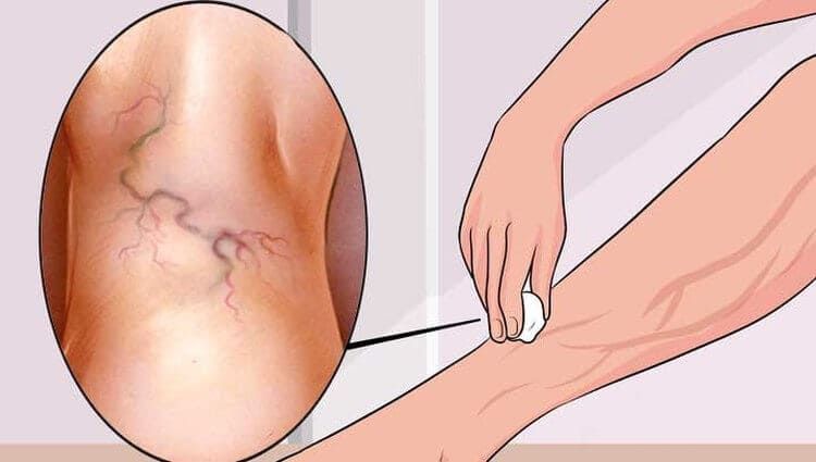 Es dolorosa la operación de varices