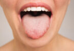 Lengua Irritada